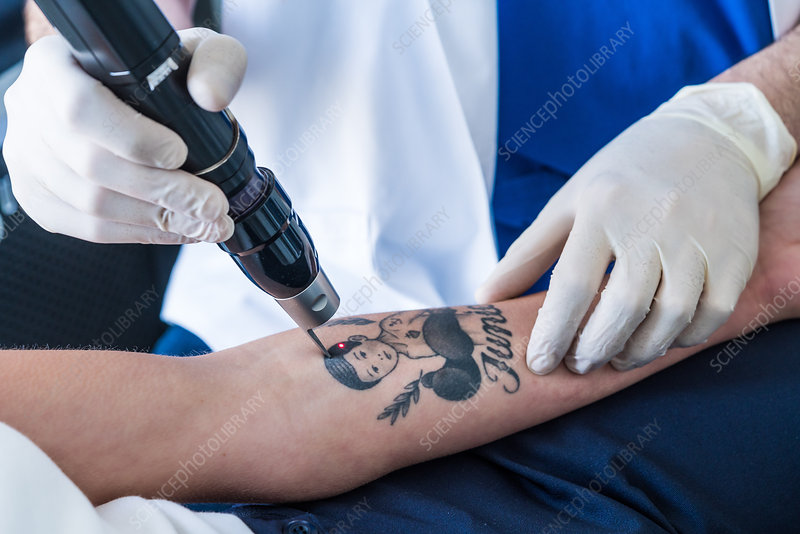 Picosecond laser tattoo removal techniques
