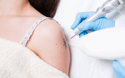 laser tattoo removal techniques