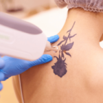 Laser Tattoo Removal – Advantages And Risks