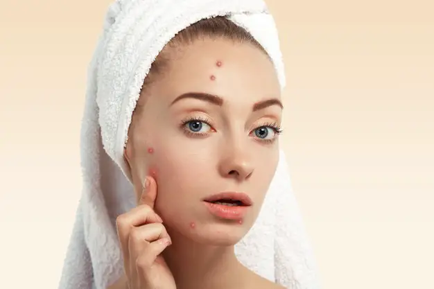 How to get rid of pimples fast