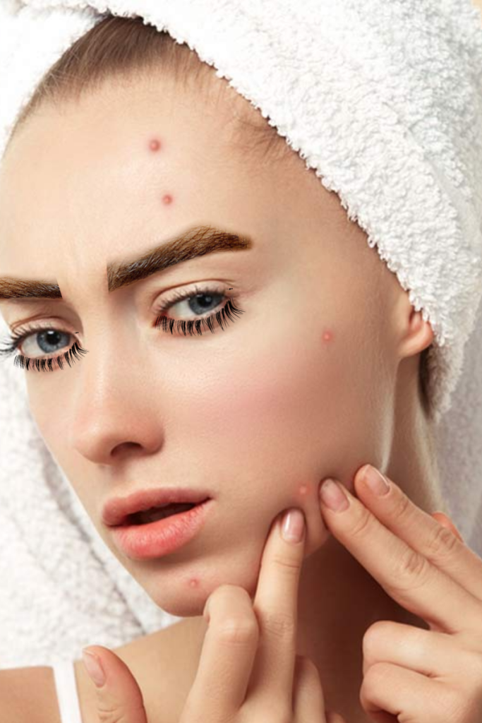 Curing pimples