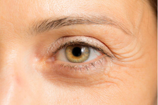 How Can I Get Rid Of Eye Wrinkles Naturally
